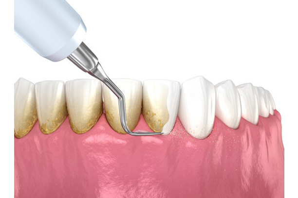 Cavity Filling